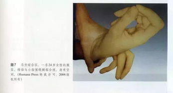 马凡氏综合症早期症状，马凡氏综合症能治好吗
