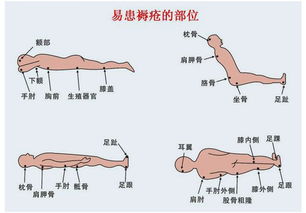 高危压疮是什么意思，压疮是什么原因引起的