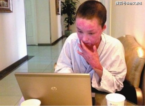 合肥毁容案真相，合肥被毁容女孩结婚了吗