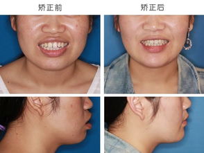 牙齿矫正是什么意思?