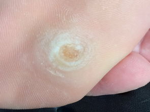 不小心得了跖疣,咋办啊?