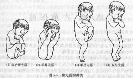 臀先露的指示点是，臀先露的表现