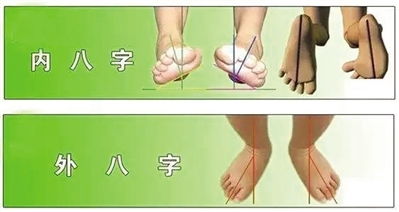 走路八字脚什么原因?
