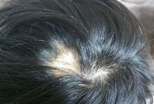 女人梦见头发秃了一块，梦见头发秃了一块什么意思