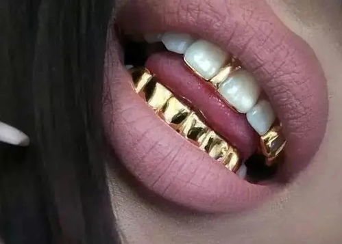 镶金牙的好处和坏处，镶金牙好吗