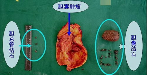 胆汁酸检查什么项目，胆汁酸高的症状