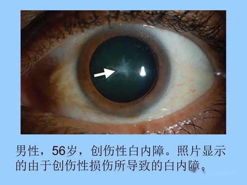 眼球的拼音