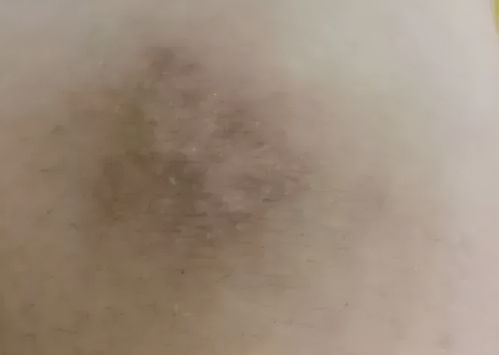 累累瘢痕怎么读，瘢痕是指什么意思