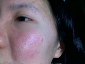 灰尘过敏是什么症状，灰尘过敏鼻炎