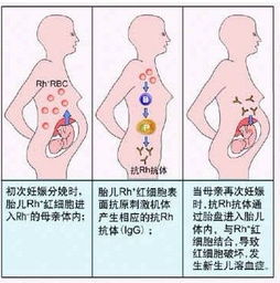 新生儿溶血是什么意思