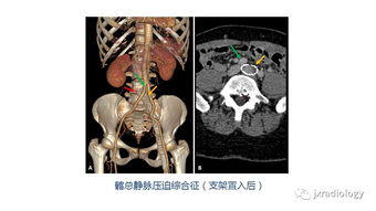 abdominal pain，abdominal aorta