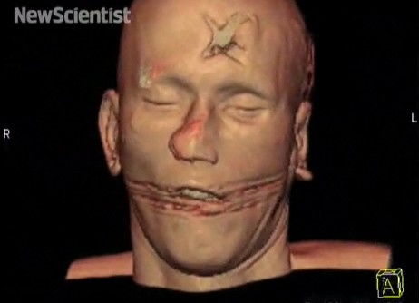 如何理解人体病理学的A(autopsy),B(biopsy)C(cytology)举例说明