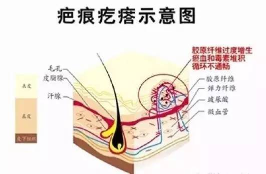 疤痕体质到底是什么意思?有哪些明显的特征?