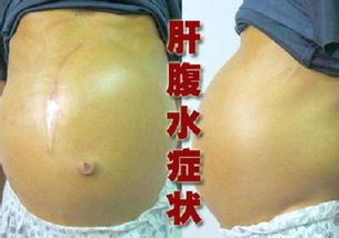 腹水产生的原因 腹水的治疗