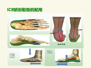 矫形支具多少钱，矫形鞋