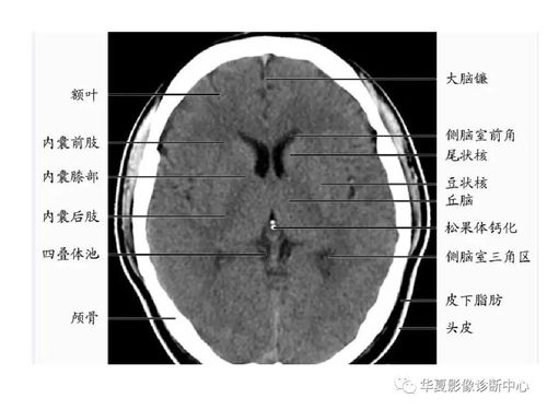 基底细胞瘤的早期表现，基底节出血
