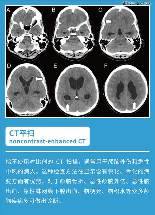 ct全称英文，帕特ct全称