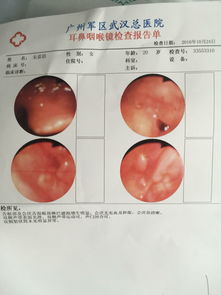 细小鱼刺几天可化解