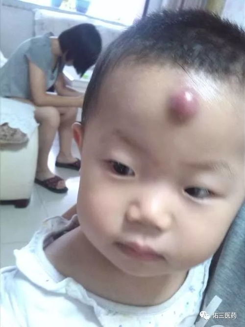 额头长疮化脓了怎么办，额头长疮是什么原因怎么调理