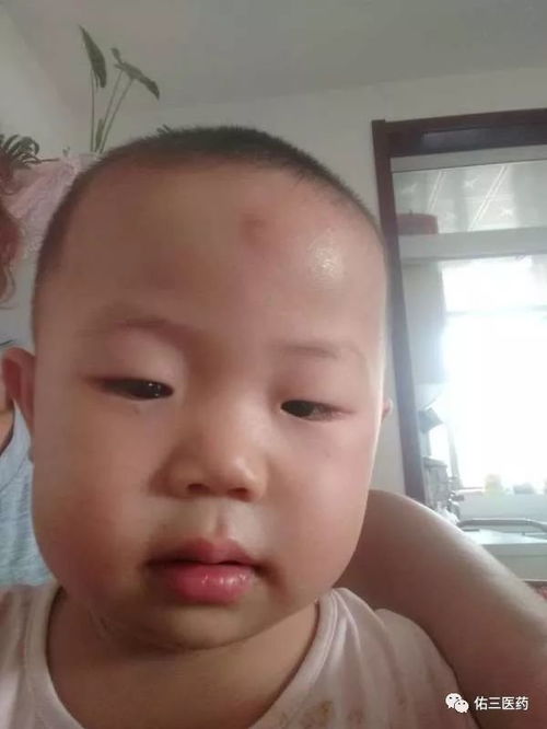 额头长了个疙瘩,像个花的样子,怎么也掉不了,这是什么东西?