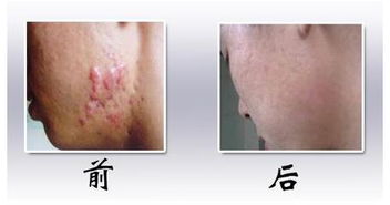 斑痕增生是什么原因引起的，斑痕画派
