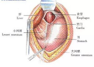 贲门肿瘤能治愈吗，贲门ca是什么意思