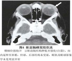 急性眼眶蜂窝织炎的病因