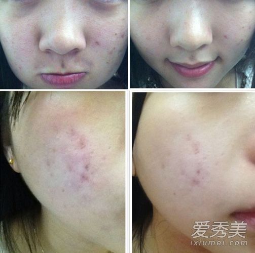 痘疤增生怎么去除，痘疤色素沉着怎么办
