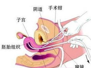 刮宫手术疼不疼,得多长时间，刮宫需要休息几天