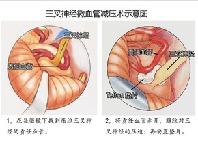 微血管减压术治疗面肌痉挛费用，微血管介入治疗肿瘤