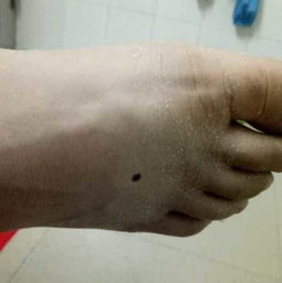 女生右脚上有痣代表什么，脚上有痣代表什么图解
