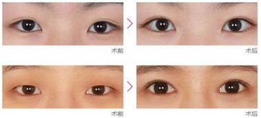 开眼角是什么情况
