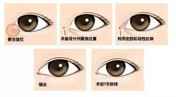 开眼角是什么手术，开眼角是怎么开的