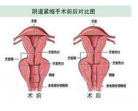 紧缩的具体含义