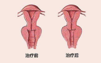 紧缩术手术大概费用，紧缩手术需要多少钱