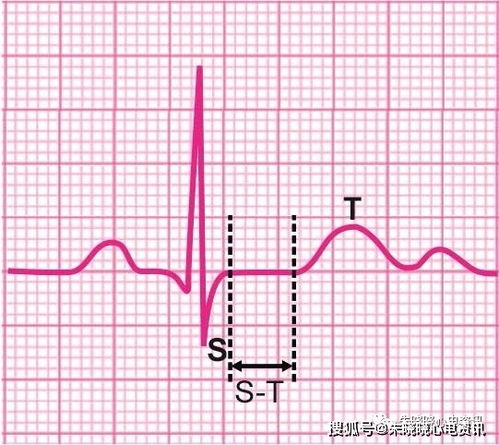 myocardial ischemia