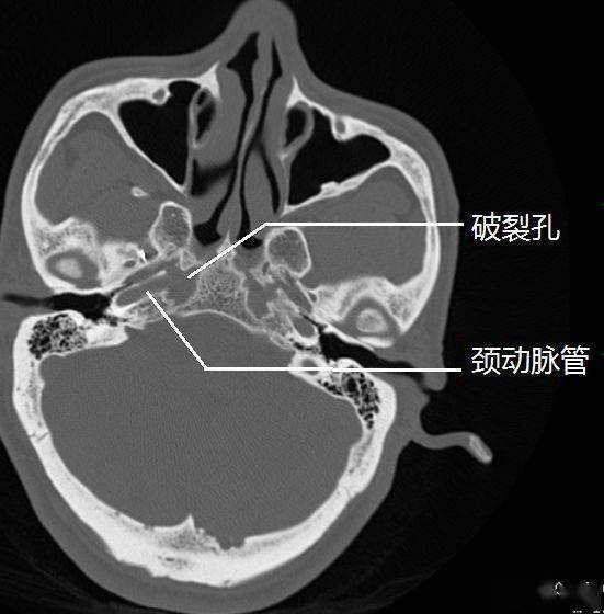 破裂空内穿过的结构