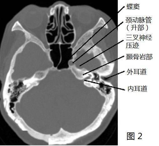 破裂孔解剖图，破裂孔和颈动脉管内口的区别