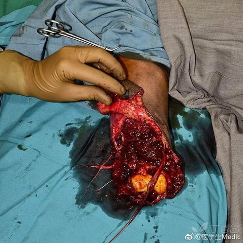 Amputation 翻译