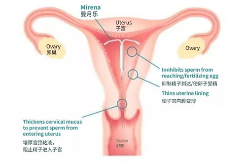 曼月乐是什么样子的那个图片，曼月乐是什么环图片