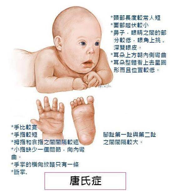 唐氏综合征的孩子不应该出生吗?