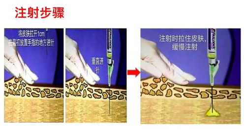 肌注就是指打屁股针吗?