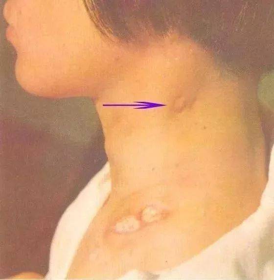 瘰疬和瘿瘤的区别，瘰疬丸的功效与主治