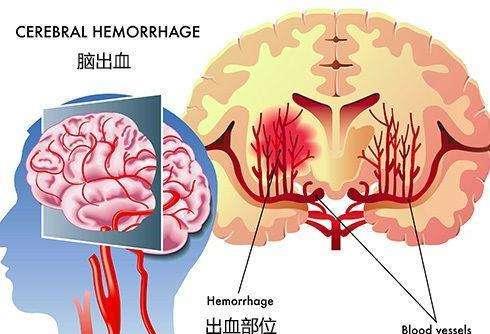 hemorrhage是什么意思，hemorrhages apiece