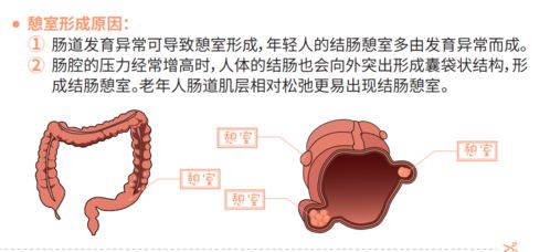 憩室造句及解释