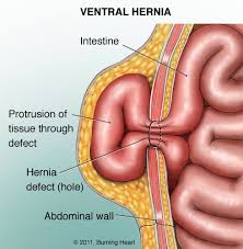hernia中文是什么意思，herniate