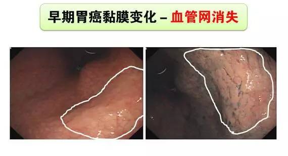 盐酸达克罗宁胶液能麻醉多久，盐酸达克罗宁的作用时长