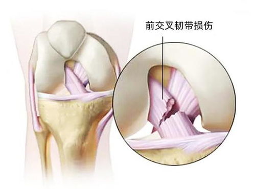 半月板撕裂是什么意思啊?