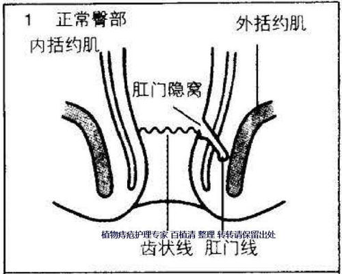 痔瘘怎么治疗，痔瘘和肛瘘有什么区别