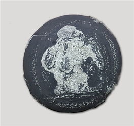 胆结石最佳治疗方法是什么?